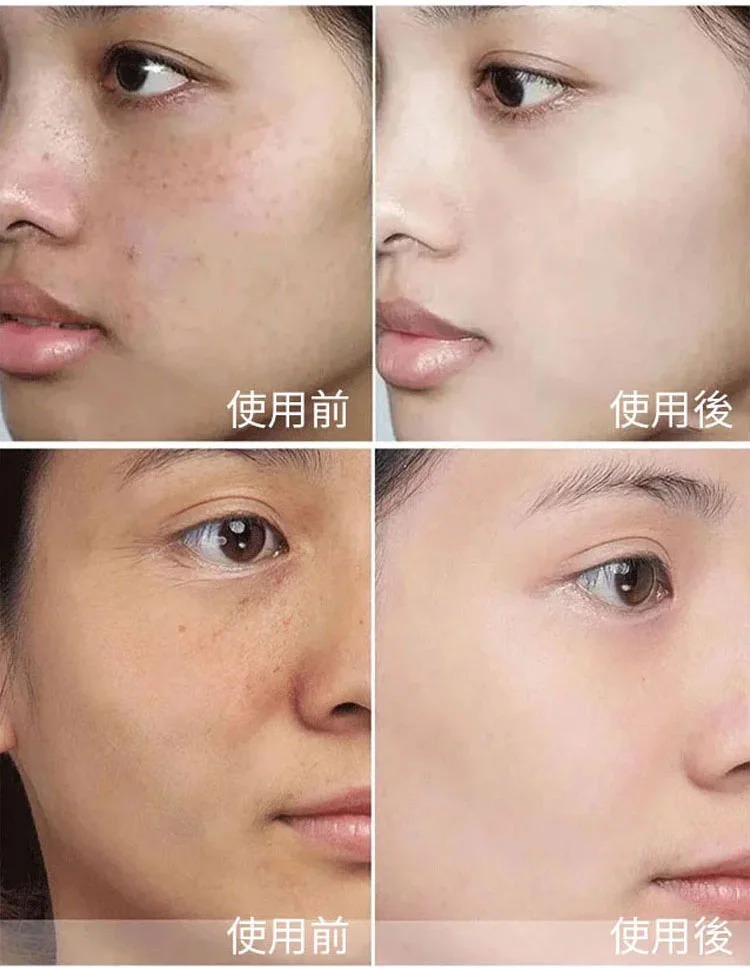 ??淡斑祛斑 美白亮膚 植物草本配方 徹底去除斑點 ??時尚雜誌和媒體傾情推!!! ??淡斑祛斑 美白亮膚 植物草本配方 徹底去除斑點 ??時尚雜誌和媒體傾情推!!!